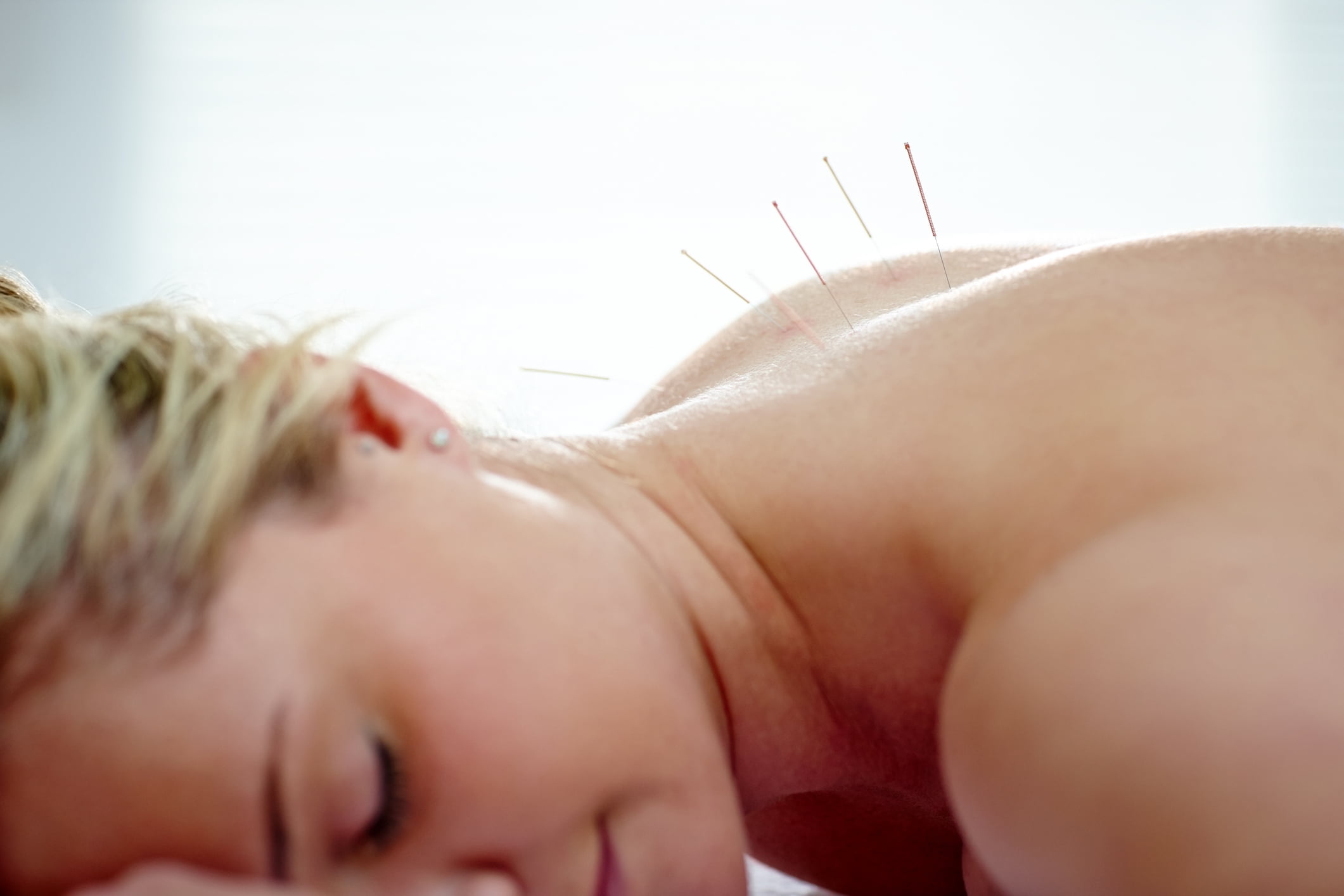 Closeup shot of woman receiving acupuncture therapy for health and beauty