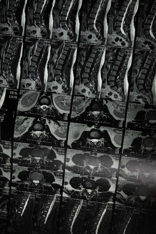 Scoliosis